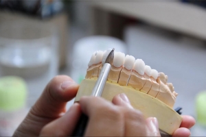 Răng tháo lắp là gì? Có nên dùng răng tháo lắp không?